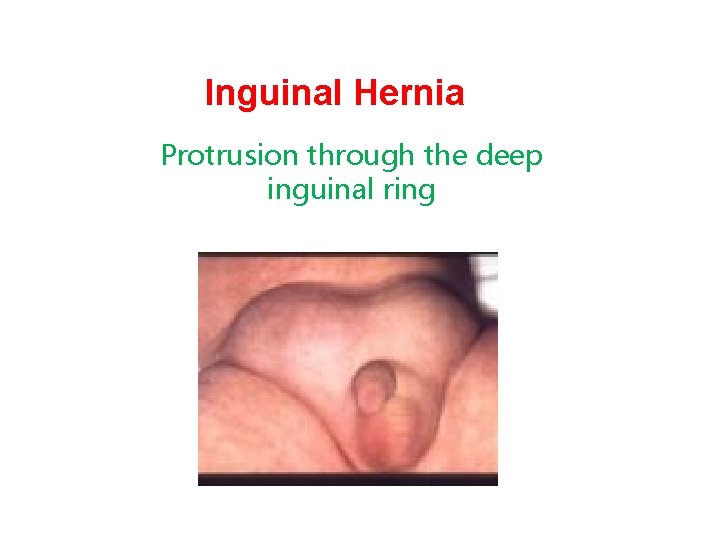 Inguinal Hernia Protrusion through the deep inguinal ring 