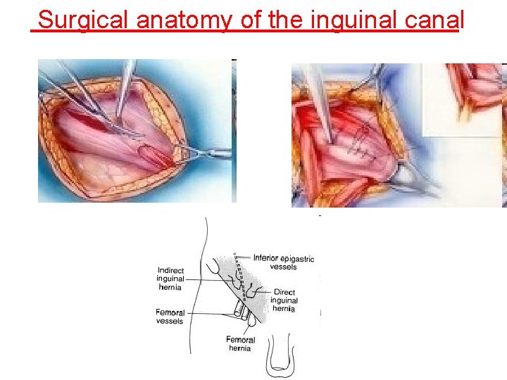 Surgical anatomy of the inguinal canal 