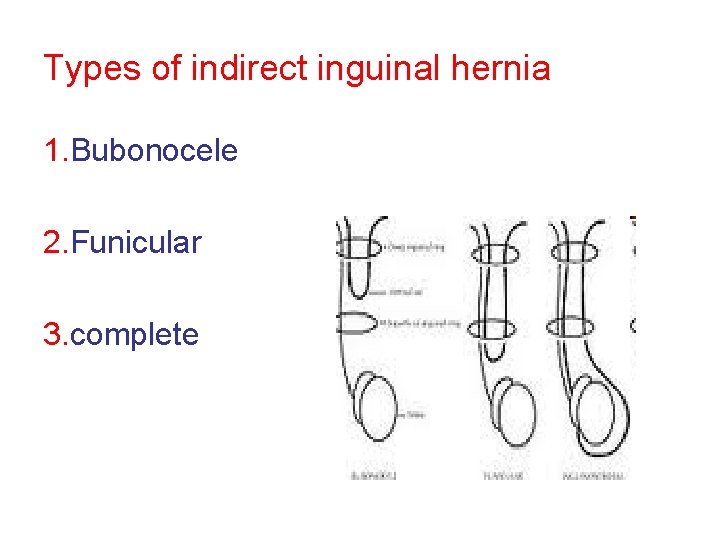 Types of indirect inguinal hernia 1. Bubonocele 2. Funicular 3. complete 