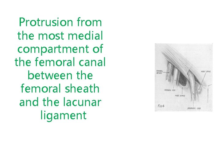 Protrusion from the most medial compartment of the femoral canal between the femoral sheath