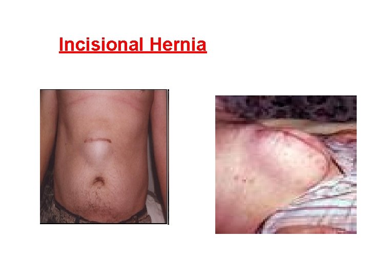 Incisional Hernia 