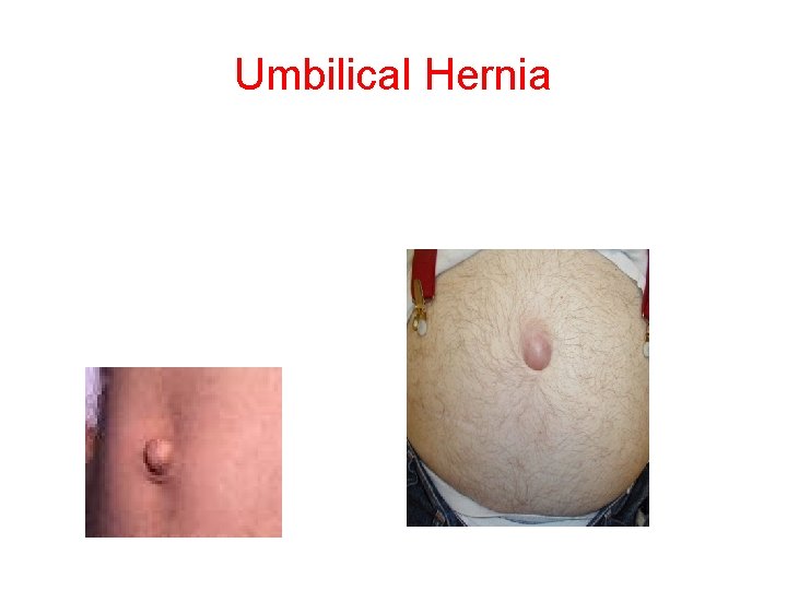 Umbilical Hernia 