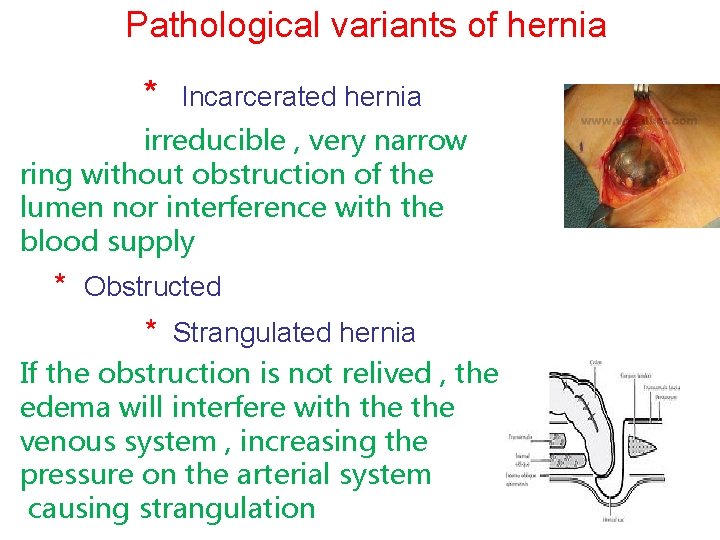 Pathological variants of hernia * Incarcerated hernia irreducible , very narrow ring without obstruction