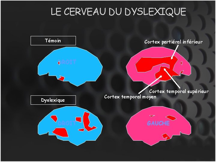 LE CERVEAU DU DYSLEXIQUE Témoin DROIT Dyslexique DROIT Cortex partiéral inférieur GAUCHE Cortex temporal