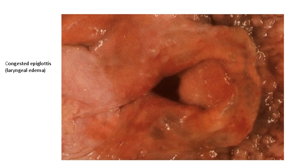 Congested epiglottis (laryngeal edema) 