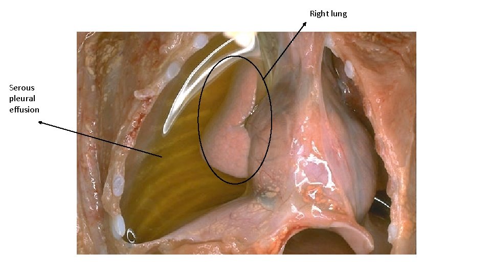 Right lung Serous pleural effusion 