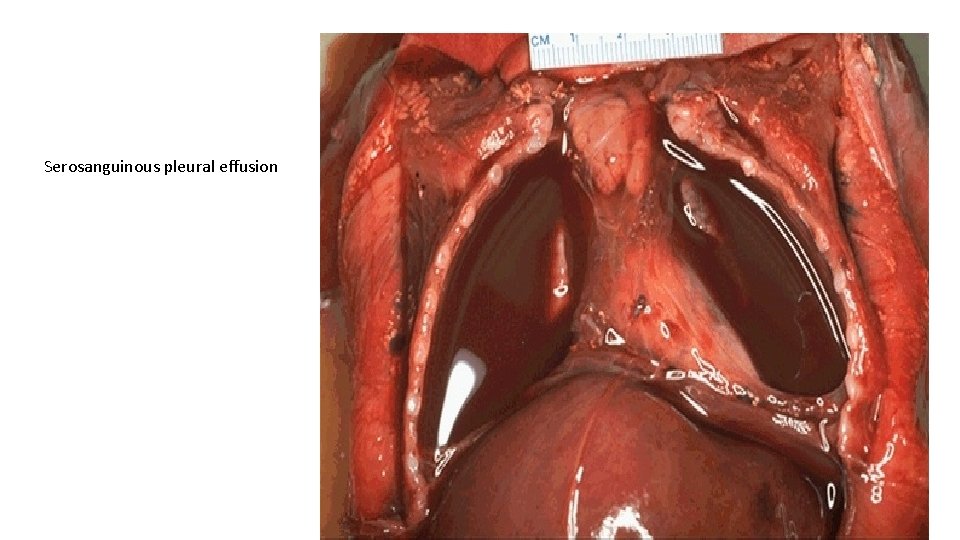 Serosanguinous pleural effusion 