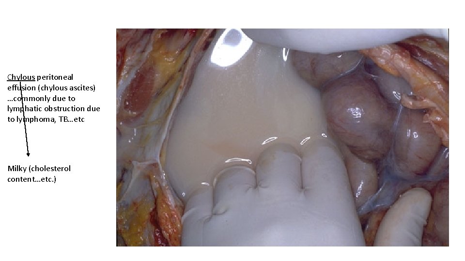 Chylous peritoneal effusion (chylous ascites) …commonly due to lymphatic obstruction due to lymphoma, TB…etc