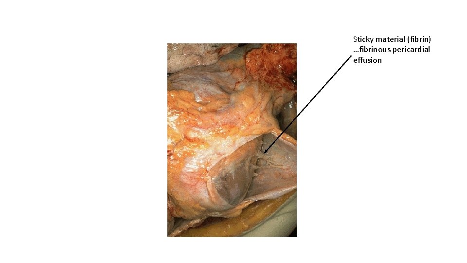 Sticky material (fibrin) …fibrinous pericardial effusion 