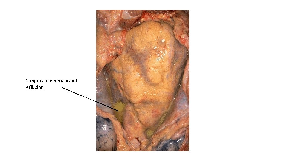 Suppurative pericardial effusion 