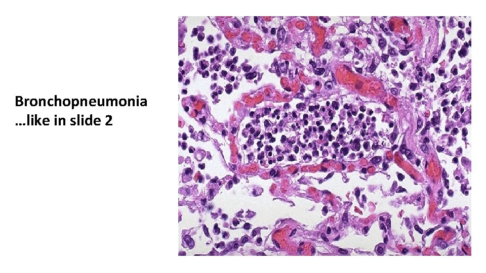 Bronchopneumonia …like in slide 2 