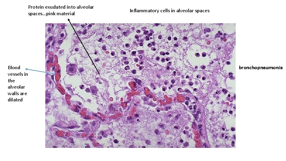 Protein exudated into alveolar spaces…pink material Blood vessels in the alveolar walls are dilated
