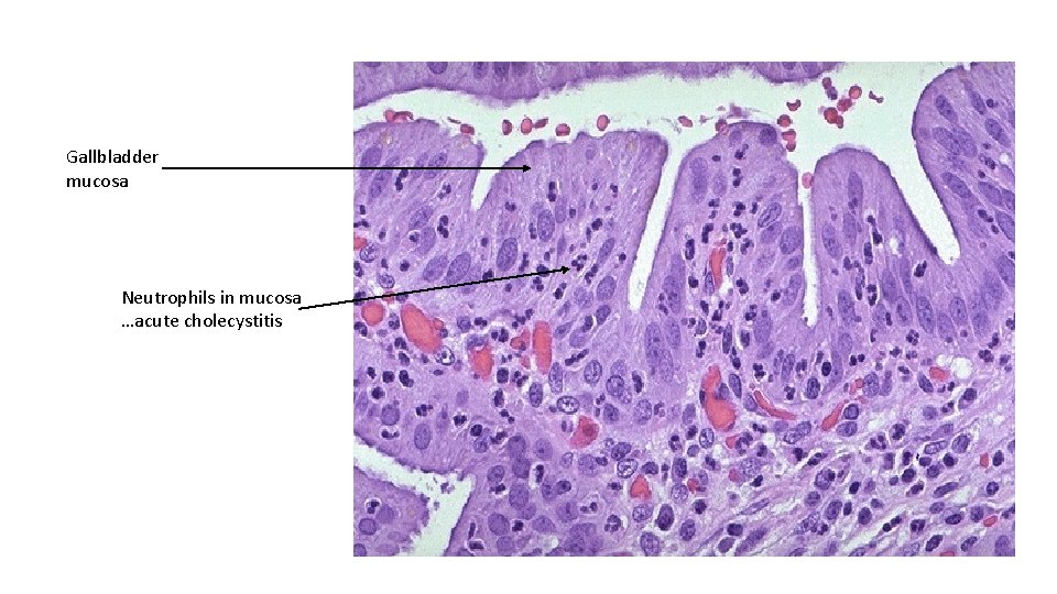 Gallbladder mucosa Neutrophils in mucosa …acute cholecystitis 