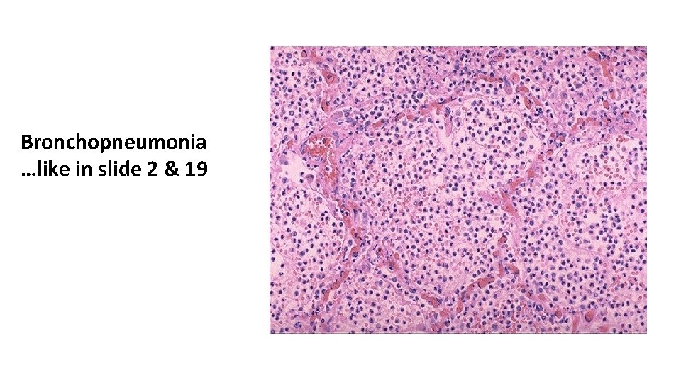 Bronchopneumonia …like in slide 2 & 19 