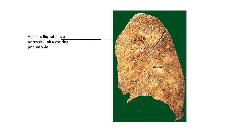 Abscess (liquefactive necrosis)…abscessizing pneumonia 