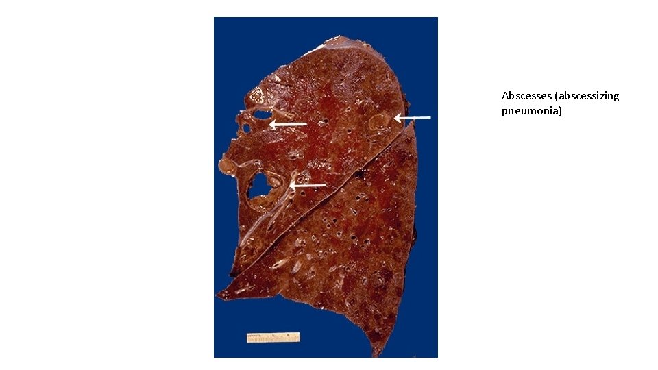 Abscesses (abscessizing pneumonia) 