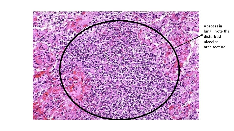 Abscess in lung…note the disturbed alveolar architecture 