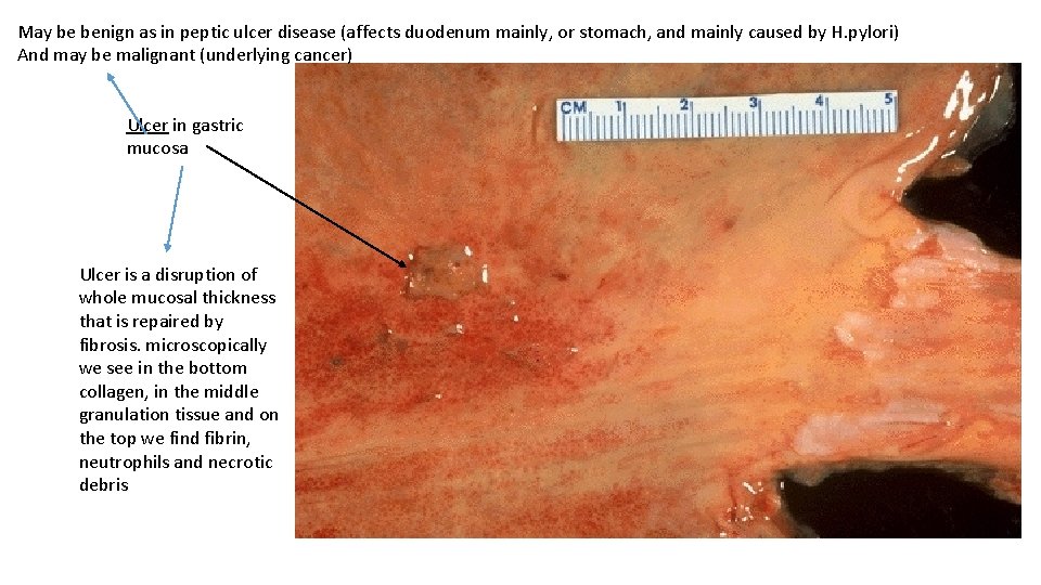 May be benign as in peptic ulcer disease (affects duodenum mainly, or stomach, and