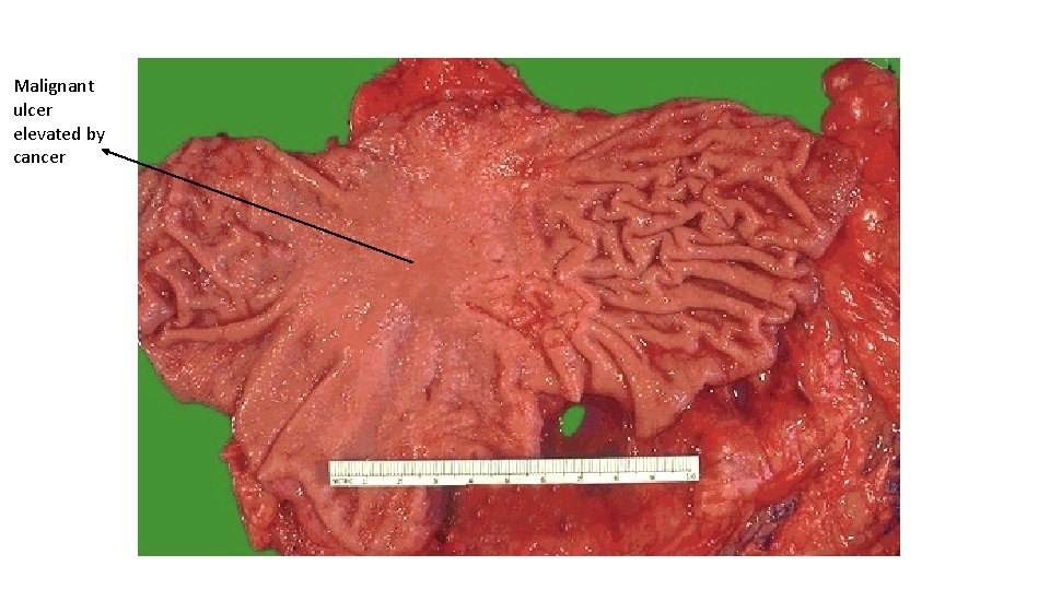 Malignant ulcer elevated by cancer 