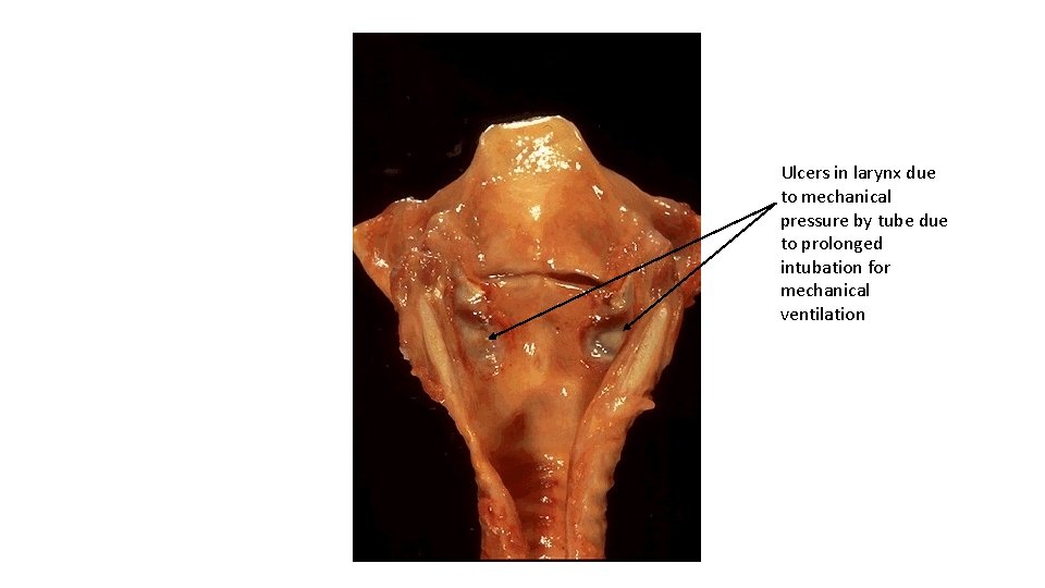 Ulcers in larynx due to mechanical pressure by tube due to prolonged intubation for