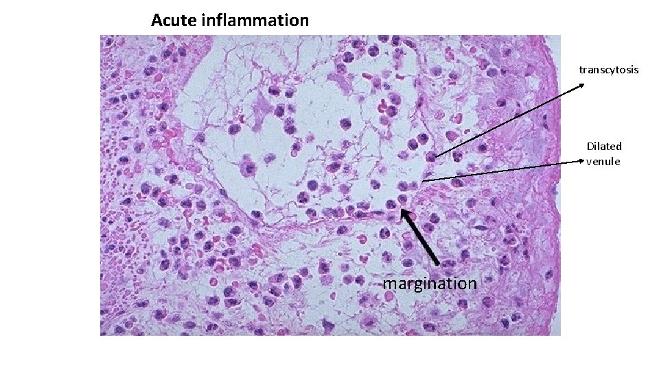 Acute inflammation transcytosis Dilated venule margination 