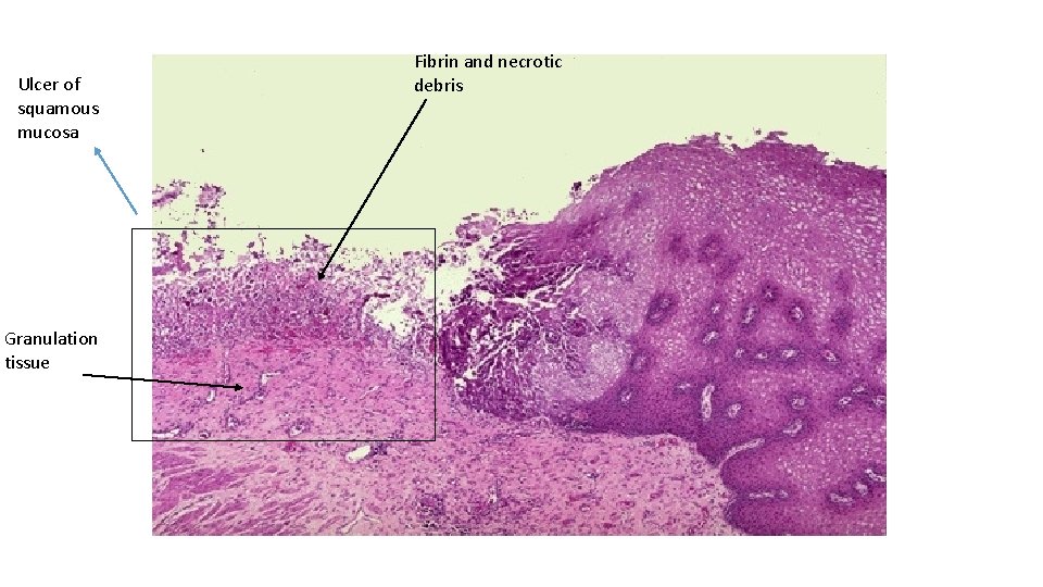 Ulcer of squamous mucosa Granulation tissue Fibrin and necrotic debris 
