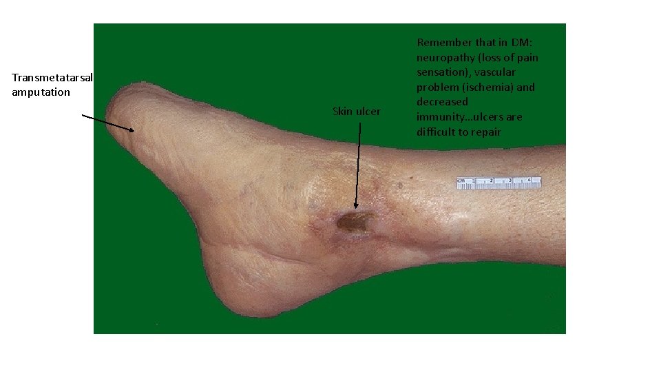 Transmetatarsal amputation Skin ulcer Remember that in DM: neuropathy (loss of pain sensation), vascular