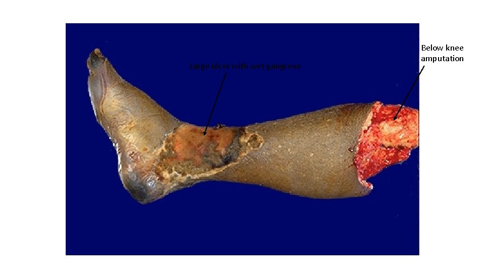 Large ulcer with wet gangrene Below knee amputation 