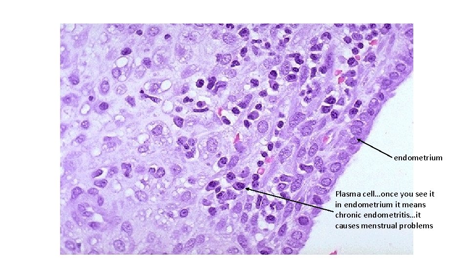 endometrium Plasma cell…once you see it in endometrium it means chronic endometritis…it causes menstrual