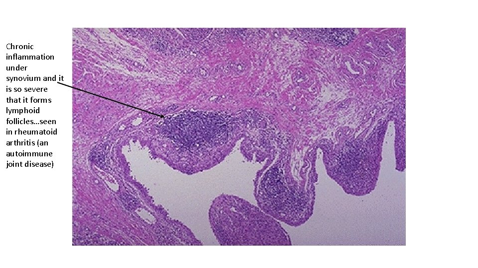 Chronic inflammation under synovium and it is so severe that it forms lymphoid follicles…seen