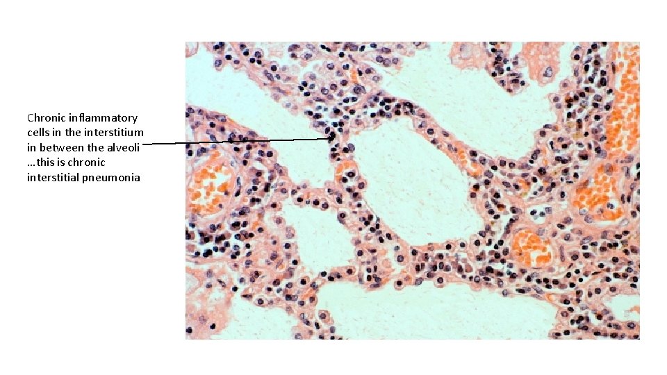 Chronic inflammatory cells in the interstitium in between the alveoli …this is chronic interstitial