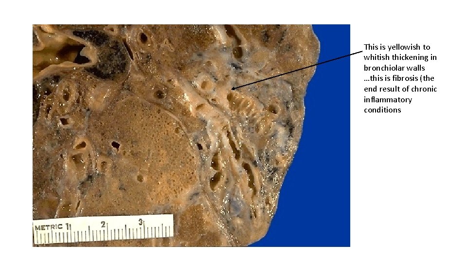 This is yellowish to whitish thickening in bronchiolar walls …this is fibrosis (the end