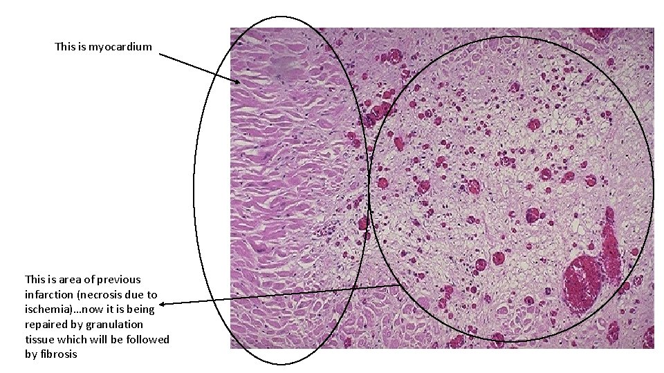 This is myocardium This is area of previous infarction (necrosis due to ischemia)…now it
