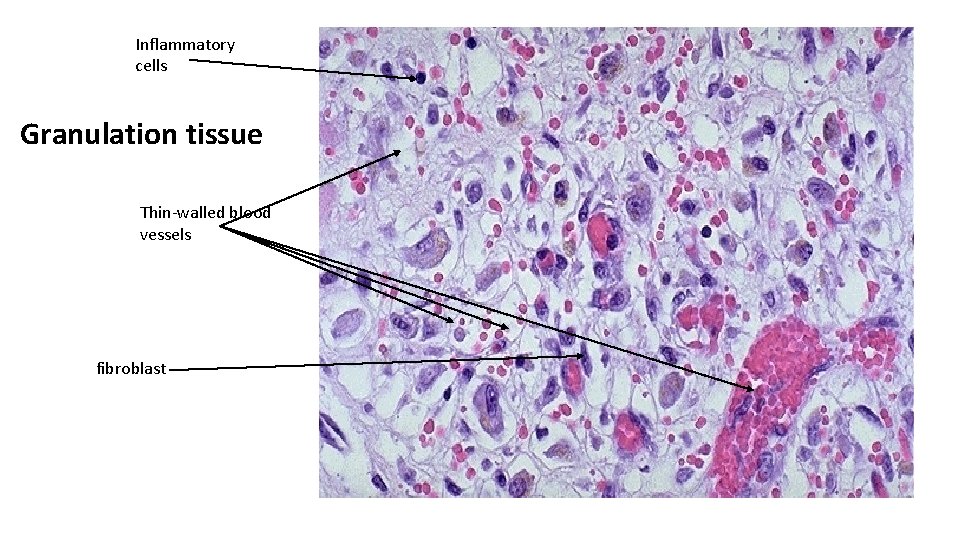 Inflammatory cells Granulation tissue Thin-walled blood vessels fibroblast 