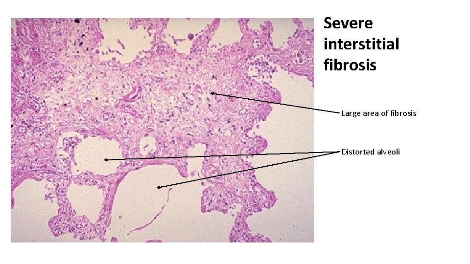 Severe interstitial fibrosis Large area of fibrosis Distorted alveoli 