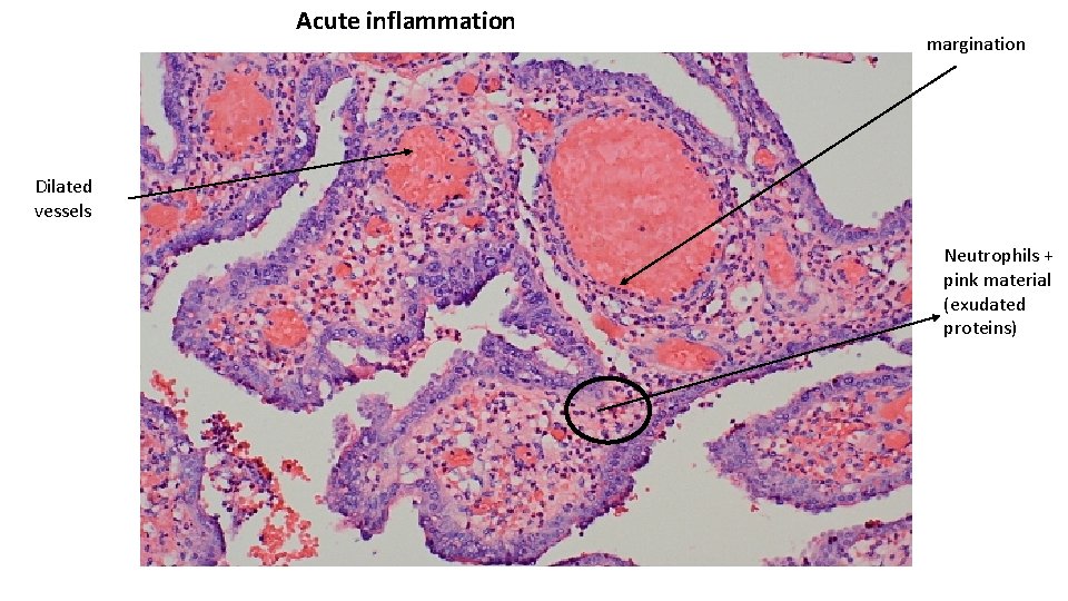 Acute inflammation margination Dilated vessels Neutrophils + pink material (exudated proteins) 