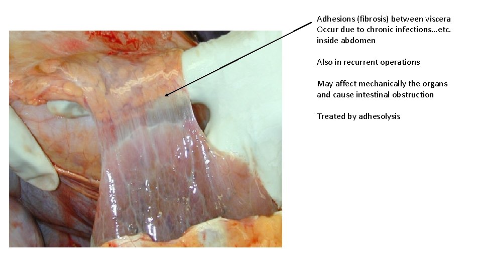 Adhesions (fibrosis) between viscera Occur due to chronic infections…etc. inside abdomen Also in recurrent