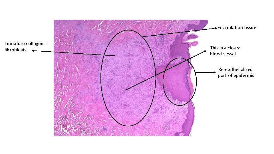 Granulation tissue Immature collagen + fibroblasts This is a closed blood vessel Re-epithelialized part