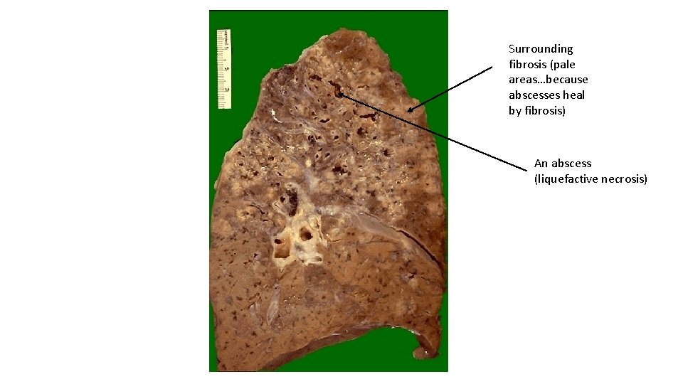 Surrounding fibrosis (pale areas…because abscesses heal by fibrosis) An abscess (liquefactive necrosis) 