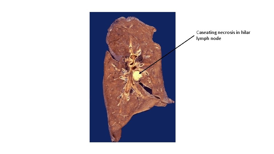 Caseating necrosis in hilar lymph node 