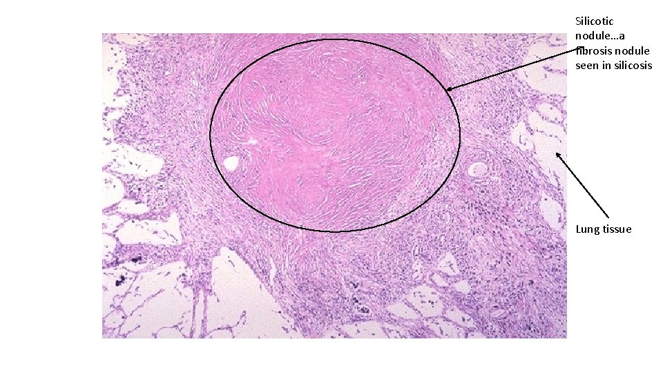 Silicotic nodule…a fibrosis nodule seen in silicosis Lung tissue 