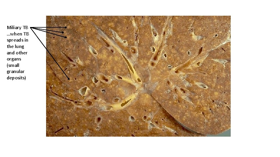 Miliary TB …when TB spreads in the lung and other organs (small granular deposits)