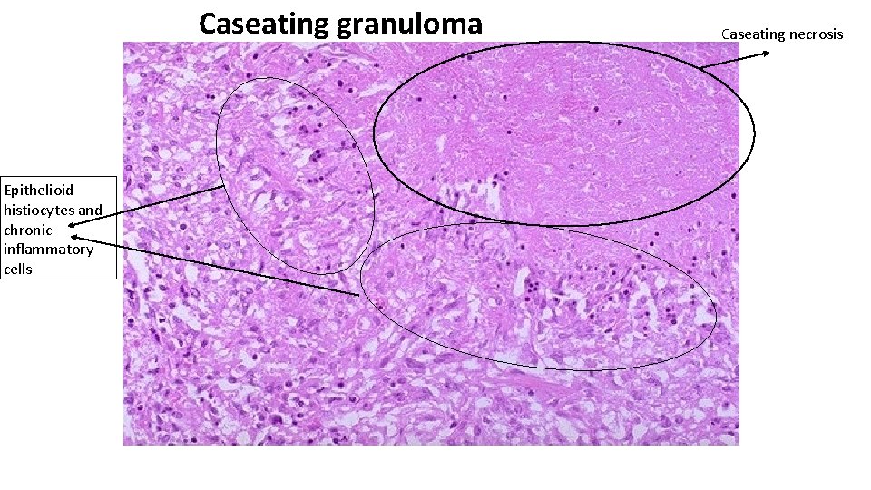 Caseating granuloma Epithelioid histiocytes and chronic inflammatory cells Caseating necrosis 