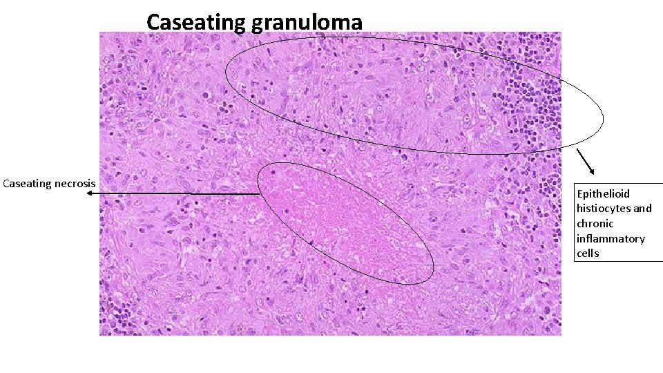 Caseating granuloma Caseating necrosis Epithelioid histiocytes and chronic inflammatory cells 