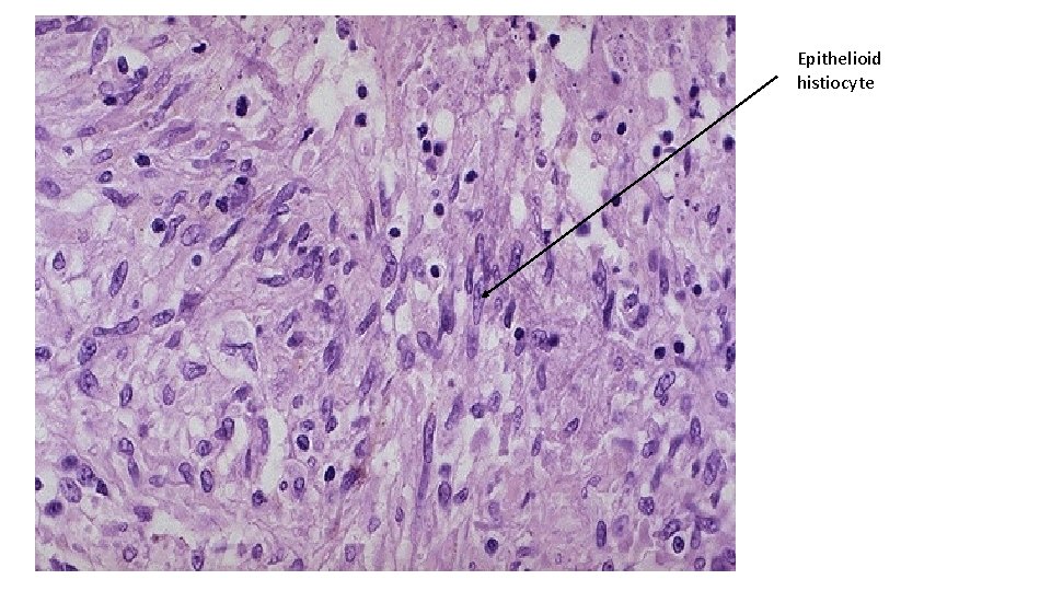 Epithelioid histiocyte 