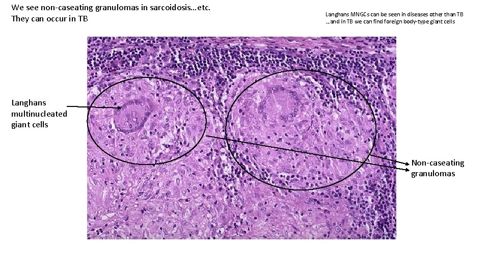 We see non-caseating granulomas in sarcoidosis…etc. They can occur in TB Langhans MNGCs can