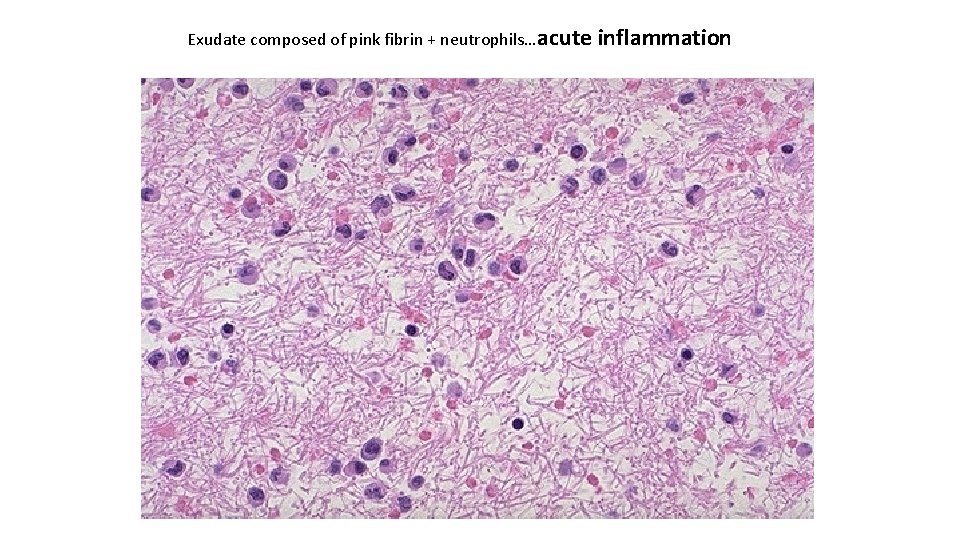 Exudate composed of pink fibrin + neutrophils…acute inflammation 