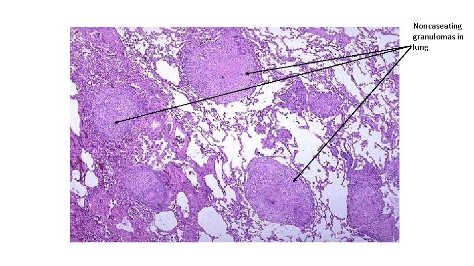 Noncaseating granulomas in lung 