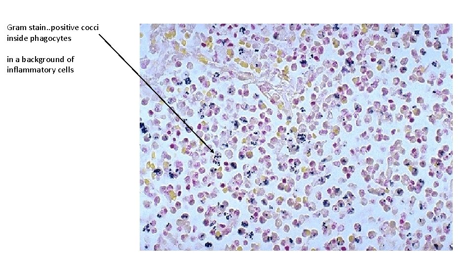 Gram stain. . positive cocci inside phagocytes in a background of inflammatory cells 