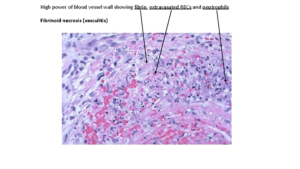 High power of blood vessel wall showing fibrin, extravasated RBCs and neutrophils Fibrinoid necrosis